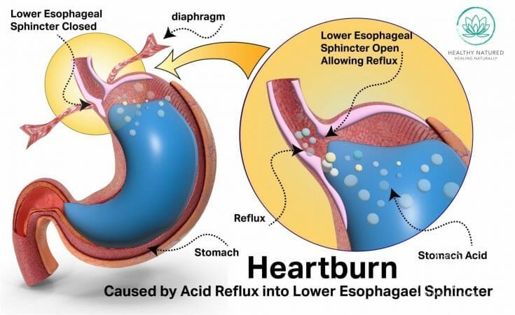 natural remedies for heartburn