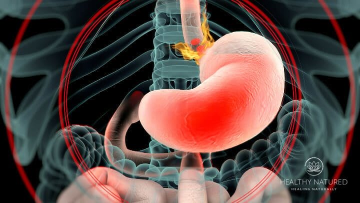 acid reflux