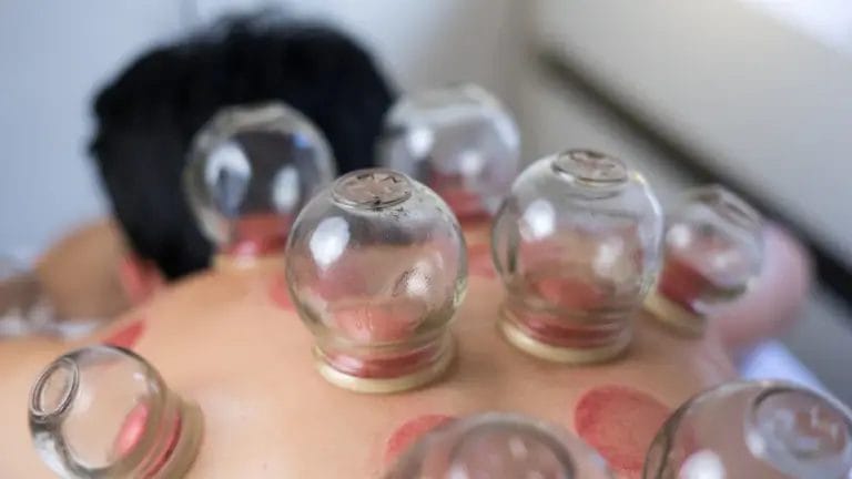 Acupuncture Cupping Therapy - Suctioning